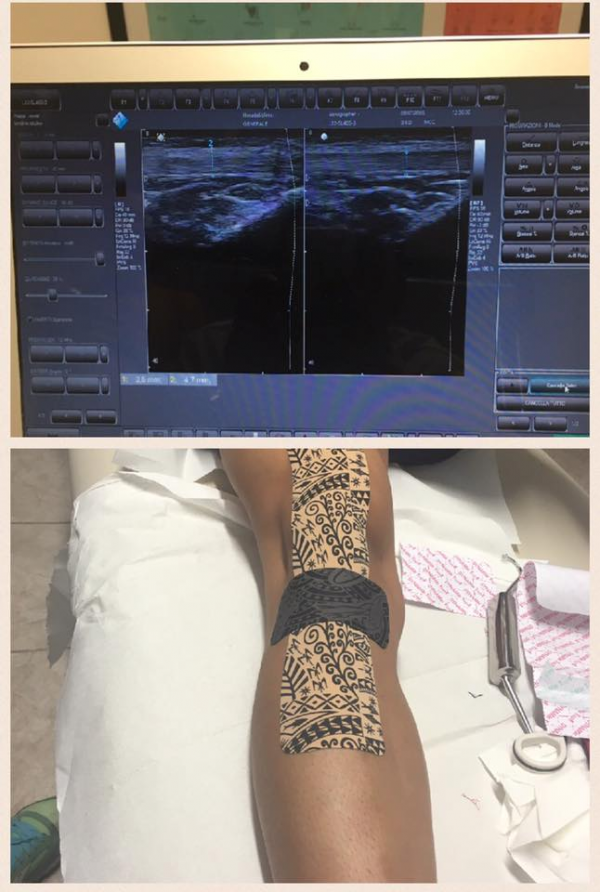 Dynamic Tape Ultrasound Measurement